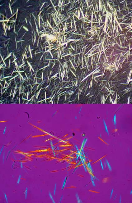 uric acid crystals