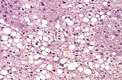 steatosis