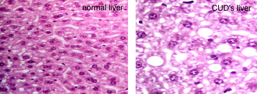 fatty liver